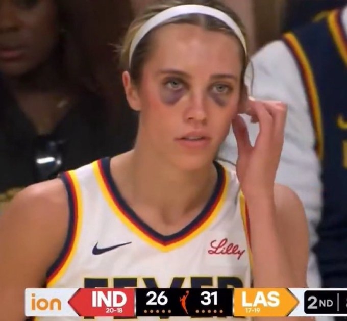 強度趕上CBA！??WNBA狂熱前鋒赫爾被“打成熊貓”了